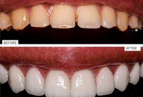 Best Dental Veneers in Al Ain | Porcelain Dental Veneers In Al Ain