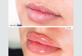 Fillers Treatment Al Ain | Filler In Al Ain | Al Andalus Medical Center