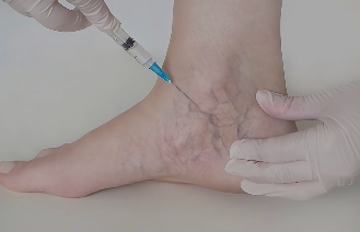 Essential Sclerotherapy Training: Master Vein Treatments | by Stellawinson | Aug, 2024 | Medium